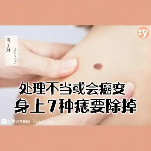 据星洲日报日前报道,美国一名女子18岁时发现大腿内侧长了一颗黑痣