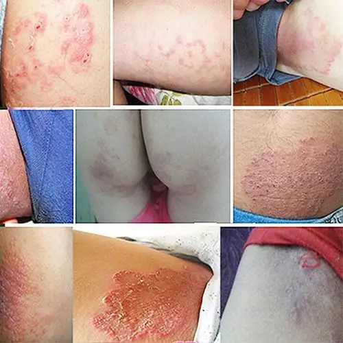 大腿内侧痒皮肤止痒膏肛门潮湿屁眼男士阴囊女性身上私处屁股瘙痒