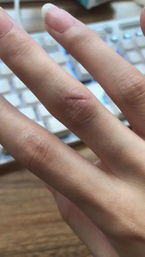 这个伤口需要打破伤风吗?