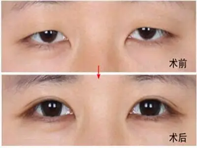 双眼皮为什么比单眼皮好看些呢?