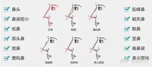 怎样才算塌鼻梁?