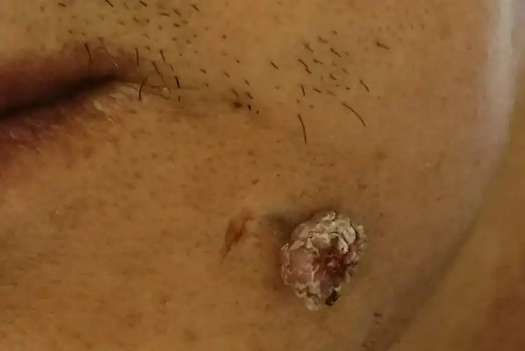 下巴长肉疣图片_图文_文章_美咯_让您放心美!