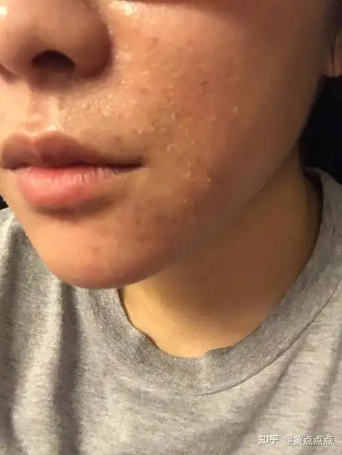 其实我的皮肤可能也是有一部分遗传的,家里爸爸妈妈的皮肤都偏干,我