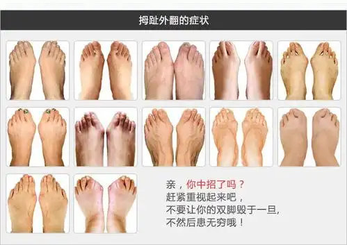 儿童拇指外翻是怎么形成的,要怎么矫正?