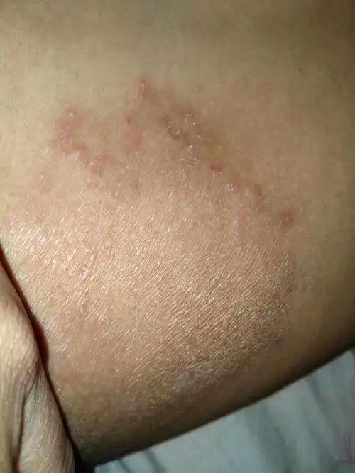 请问一下,这是股癣吗?