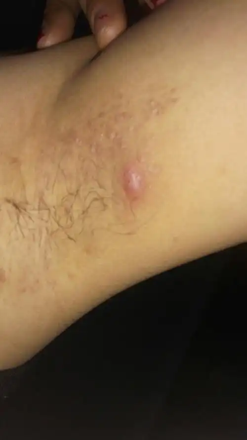腋下长了一个大痘,一捏就疼,一捏感觉里面还有圆圆的东西,不硬!
