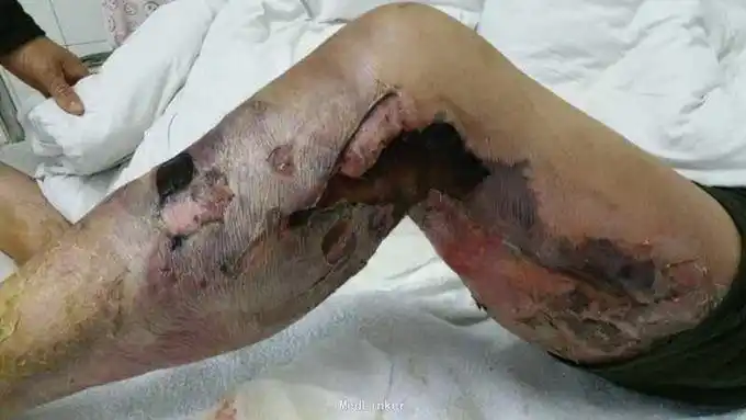 左下肢皮肤坏死