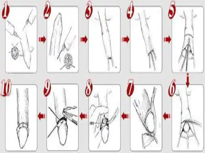 男性包皮环切手术及护理