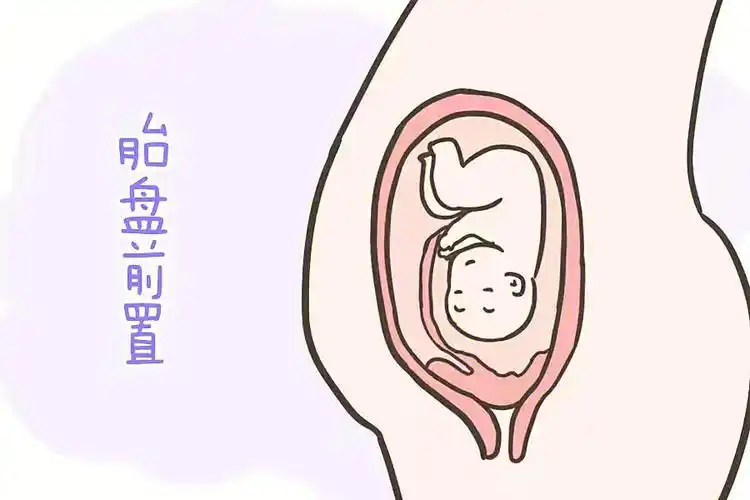 完全性前置胎盘