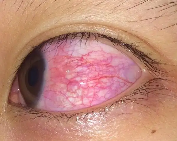 眼白充满红血丝,怎么办