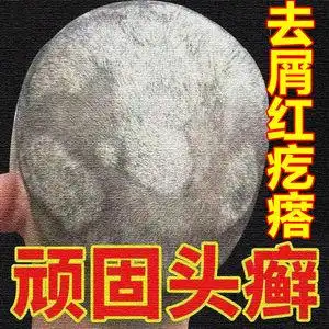头癣药膏银屑癣治顽固性皮癣皮痒头皮癣藓真菌感染毛囊炎头部专用