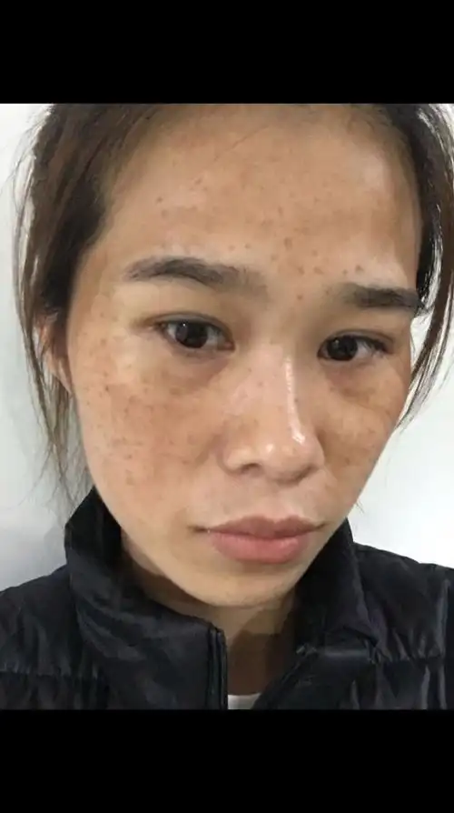 脸上斑好了就是最近皮肤有点干,谁用过补水效果好点的水乳吗?