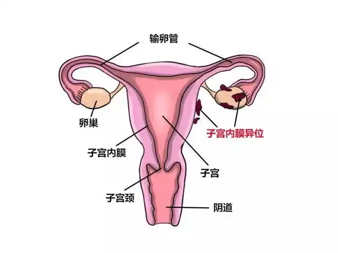 (图片源自网络)全球约10%的育龄期女性存在子宫内膜异位症,且发病率逐
