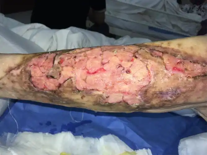 小腿碾压撕脱伤病情演变过程