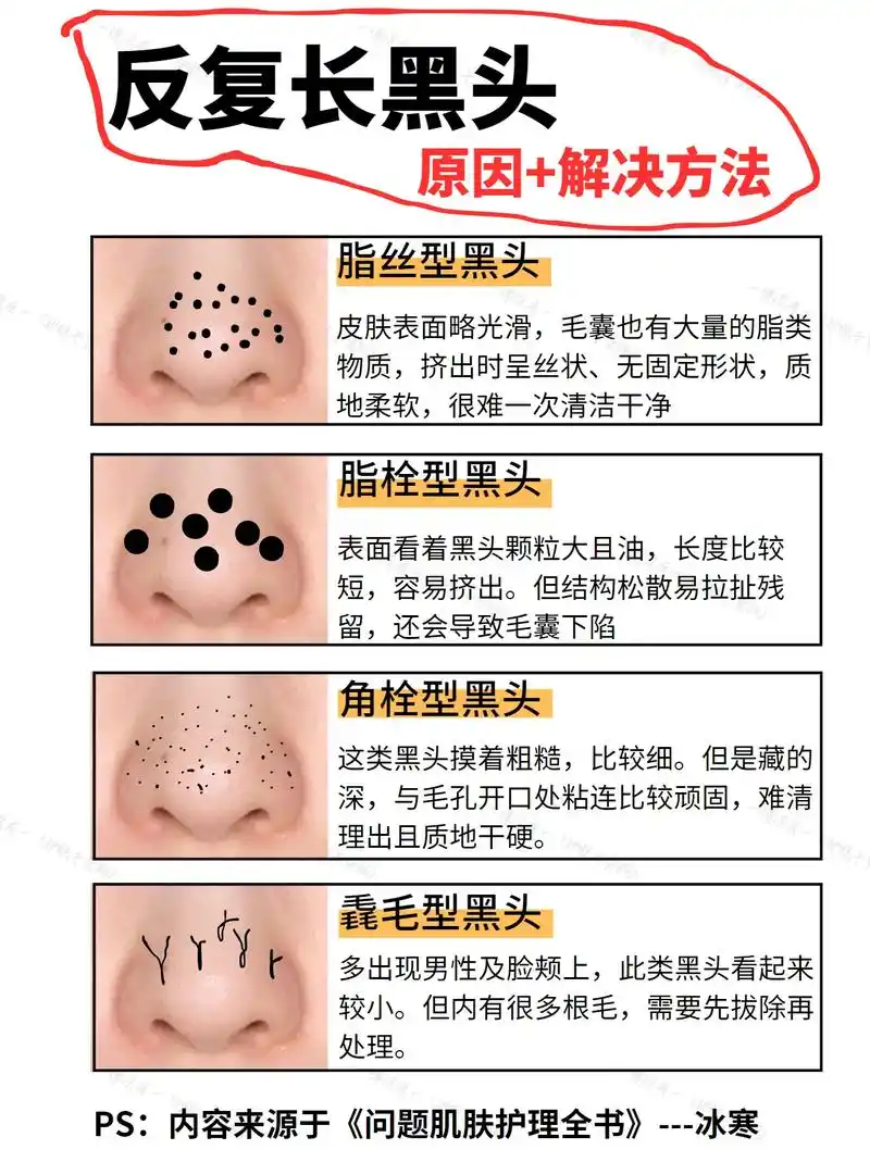 黑头教程75亲测有效.#创作灵感 #图文 - 抖音