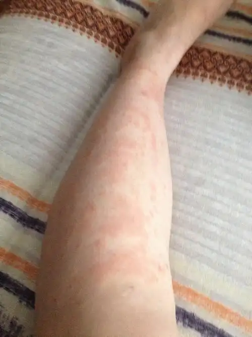 问:孕三十二周严重过敏性湿疹,现在不怎么痒了,可是皮肤变成这种了,会