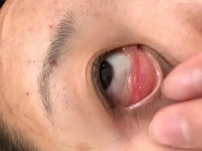 病情描述:右眼痒,下眼睑里面长了粉色的小肉条咨询问题:2017-09-03
