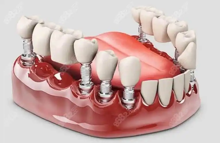 马龙桥和传统种植牙的区别是什么做半口种植选哪个好