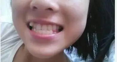 长相不好的虎牙一拔了之可以吗