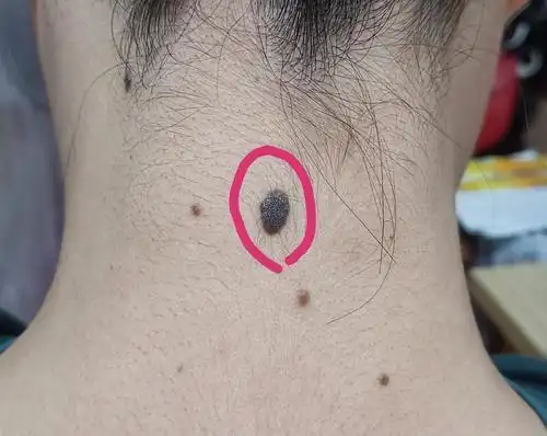 为什么有的人脖子后边有一颗痣这种痣真的代表福气吗