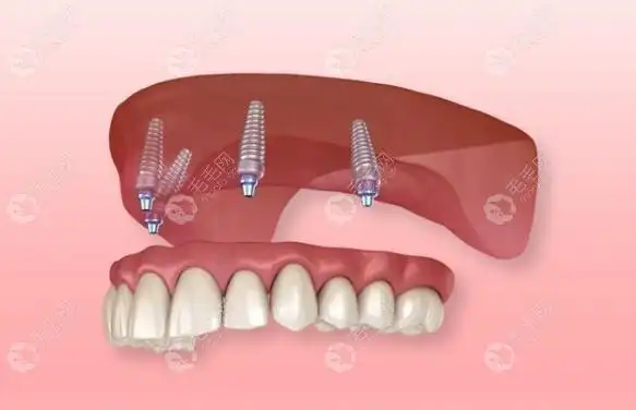 半口全固定种植牙