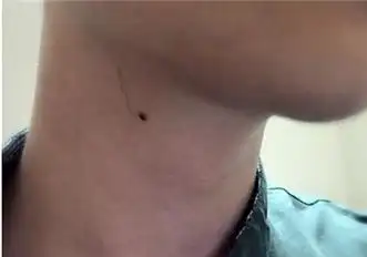 在痣相学中,男人脖子上的痣一般是左贵右富,不论痣长在左边还是右边都