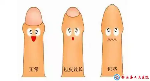 区分包皮过长和包茎包皮环切术虽然是个小手术,但是也勿盲目跟风,不是