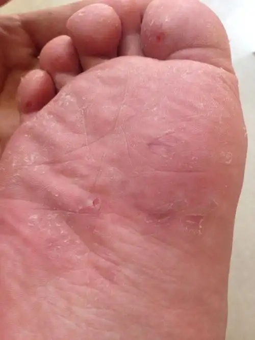 脚板底很痒很痒