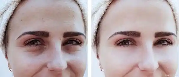 嗨体祛泪沟效果好不好?口碑如何?