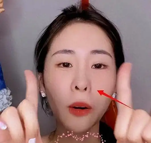 张碧晨陷整容风云嘴歪脸斜鼻孔外翻似牛魔王发际线后移认不出