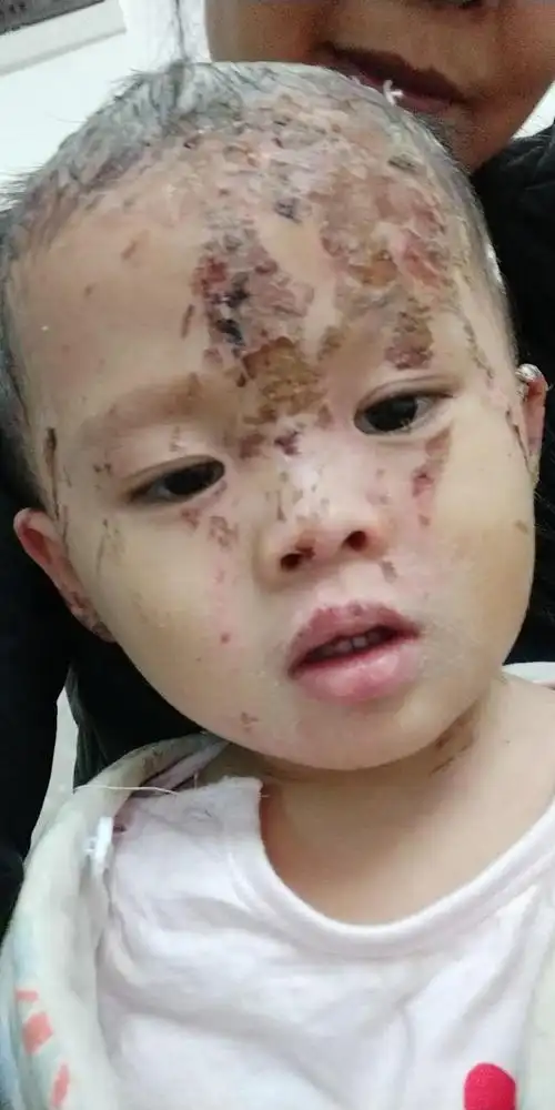 火锅开水烫伤,七天效果!