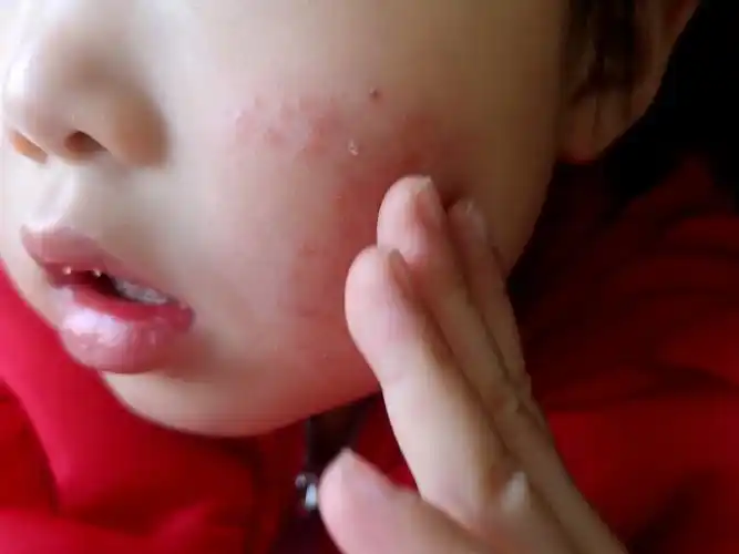 小朋友面部的皮炎究竟什么原因