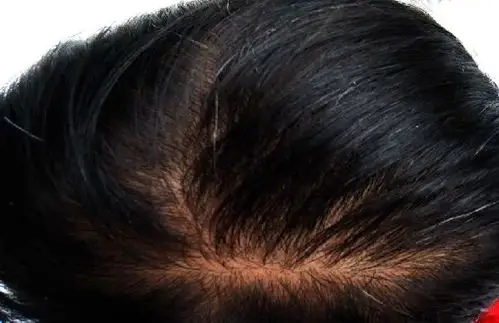 夏天掉发脱发的4个主要原因