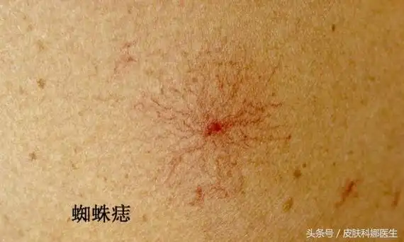 皮肤红血丝怎么办红血丝形成的原因