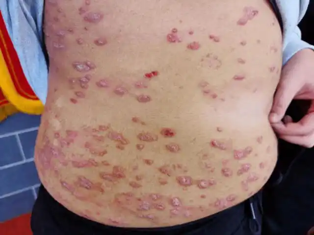 不幸的是血热论直接影响了后世医家,近现代名家及医者们治疗银屑病