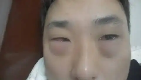 早上起床发现眼睛肿的很厉害,以前从来没有