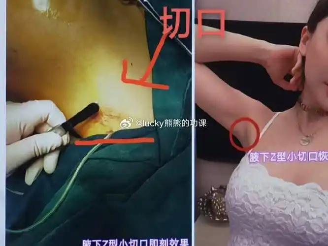 【腋下切口】很多小姐妹认为xo胸手术不看医生技术大家看看两个不同