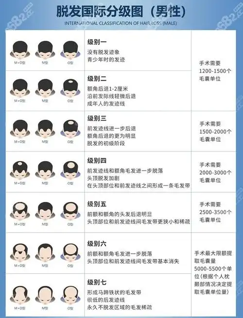 脱发17级程度图片男女士脂溢性脱发均可对照自测脱发程度