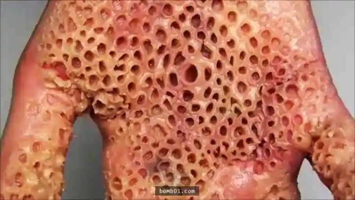 看到或想到密密麻麻聚集在一起的东西时,就会觉得感到恐惧,恶心,头晕