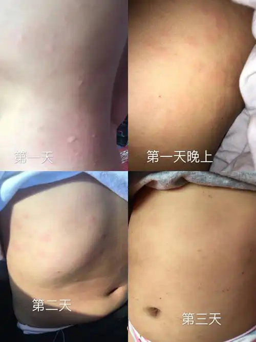 宝宝牛奶蛋白过敏起荨麻疹 ,怎么办
