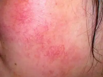 怎么才能快速修复面部红血丝不复发?