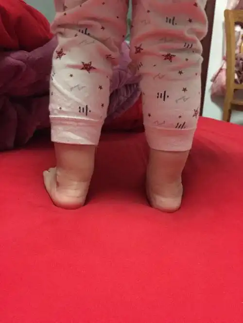 现在走路内八字很严重.做妈妈的心急如焚,还望各位