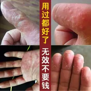 鹅掌风手癣特效