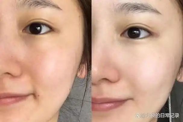 美白针可以美白全身吗?还有什么方法可以变白?