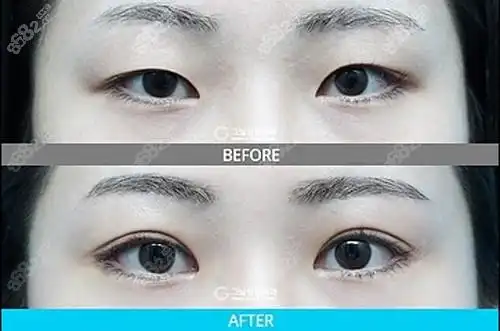 韩国歌娜整形外科割双眼皮前后对比图