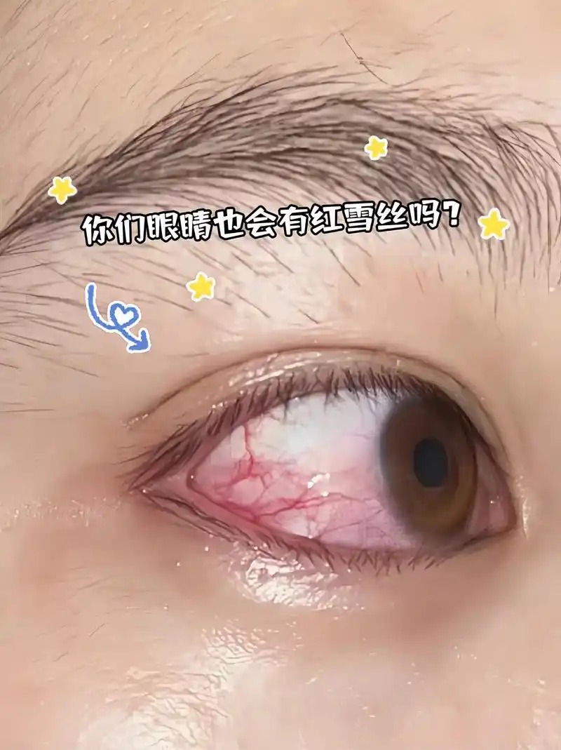 坚持用了几盒,红血丝退了好多!我真的会谢.就是它救了眼睛快瞎的我!