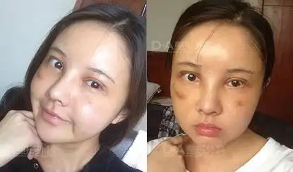 韩国da医院做面部脂肪填充眼鼻整形对比案例