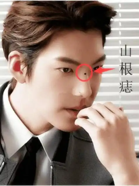 男人山根痣的位置不同,性格和事业也会有变化