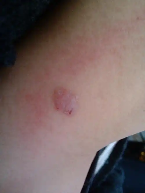 脖子上长了像癣一样的东西(不知道是不是癣),痒!