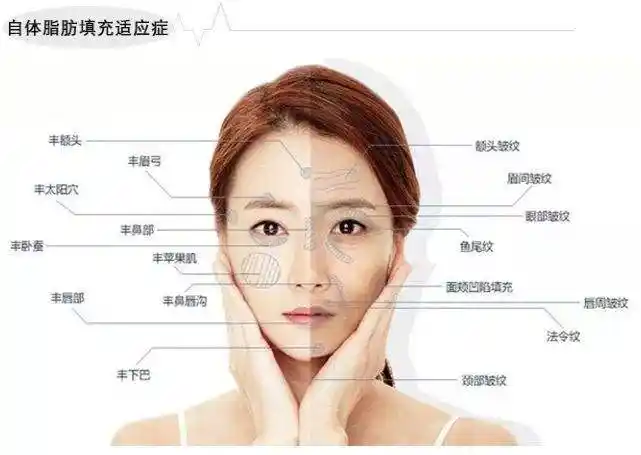 医美小科普自体脂肪全脸填充多少天消肿